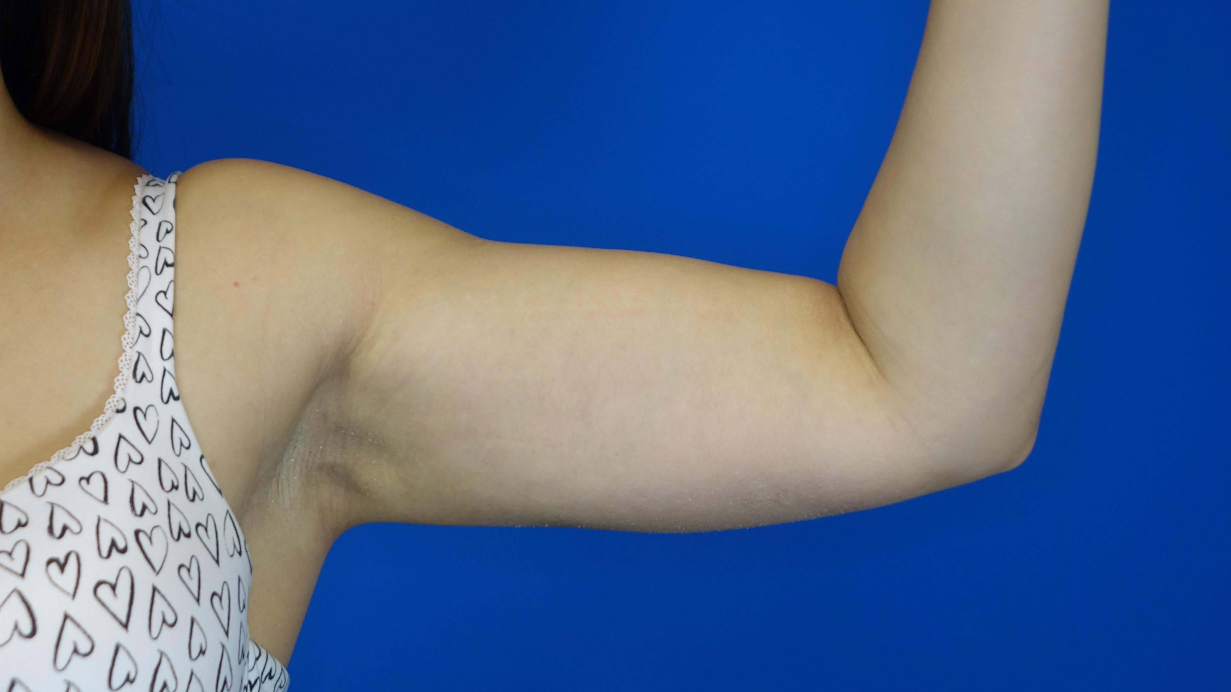 27 year-old arm after circumfe